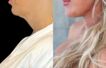 female patient before and after EVELift®