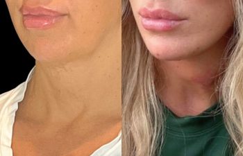 female patient before and after EVELift®