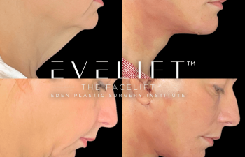 female patient before and after EVELift®