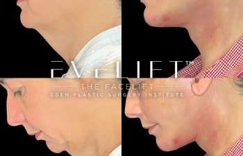 female patient before and after EVELift®