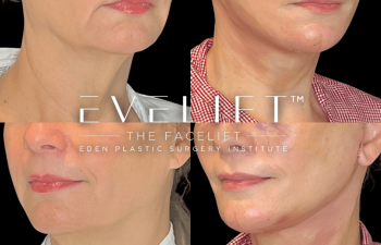 female patient before and after EVELift®