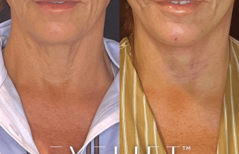 female patient before and after EVELift®
