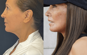 female patient before and after EVELift®
