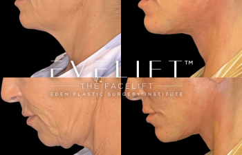 female patient before and after EVELift®