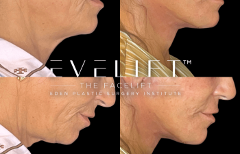 female patient before and after EVELift®