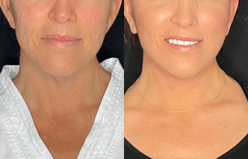 female patient before and after EVELift®