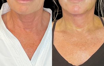 female patient before and after EVELift®