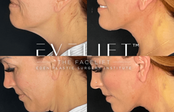 female patient before and after EVELift®