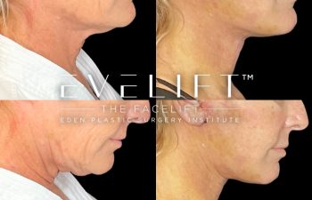 female patient before and after EVELift®