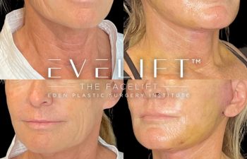 female patient before and after EVELift®