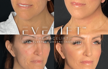 female patient before and after EVELift®