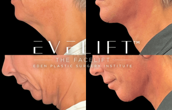 female patient before and after EVELift®