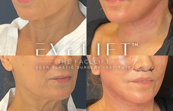 female patient before and after EVELift®
