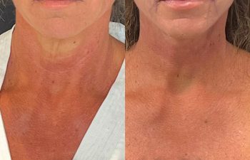 female patient before and after EVELift®