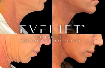 female patient before and after EVELift®