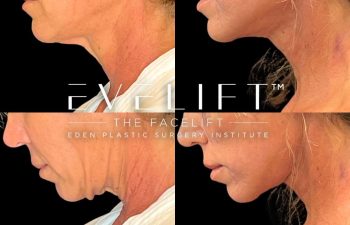 female patient before and after EVELift®