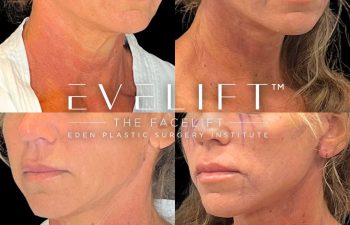 female patient before and after EVELift®