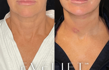 female patient before and after EVELift®
