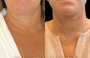 female patient before and after EVELift®