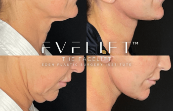 female patient before and after EVELift®