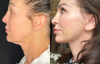 female patient before and after EVELift®