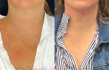 female patient before and after EVELift®