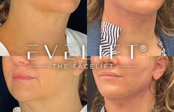 female patient before and after EVELift®
