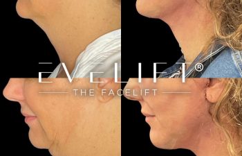 female patient before and after EVELift®