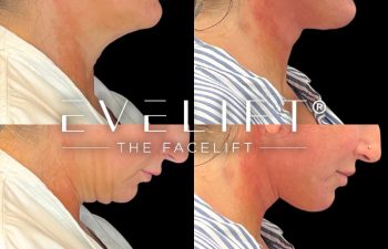 female patient before and after EVELift®