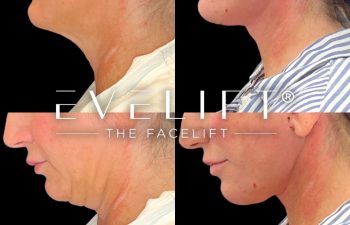 female patient before and after EVELift®