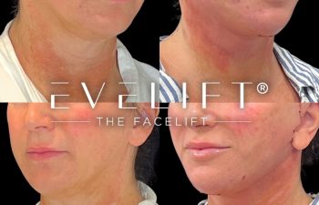 female patient before and after EVELift®