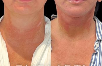 female patient before and after EVELift®