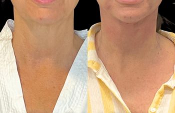 female patient before and after EVELift®