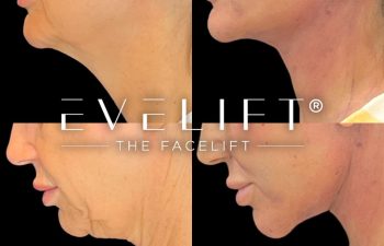 female patient before and after EVELift®