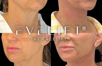 female patient before and after EVELift®
