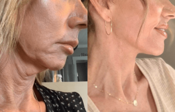 female patient before and after EVELift®