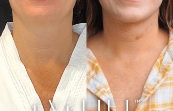 female patient before and after EVELift®