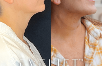 female patient before and after EVELift®