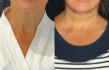 female patient before and after EVELift®