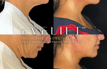 female patient before and after EVELift®