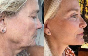 female patient before and after EVELift®