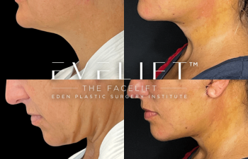 female patient before and after EVELift®