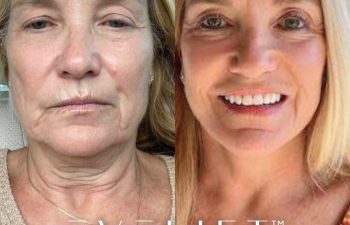 female patient before and after EVELift®