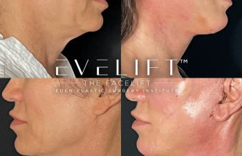 female patient before and after EVELift®