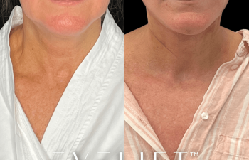 female patient before and after EVELift®