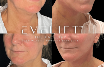 female patient before and after EVELift®