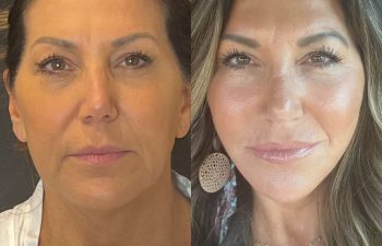 female patient before and after EVELift®