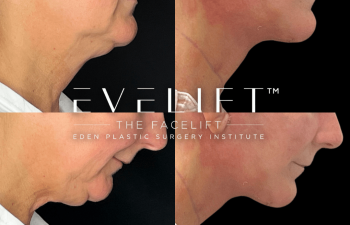 female patient before and after EVELift®