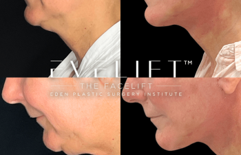 female patient before and after EVELift®