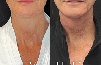 female patient before and after EVELift®